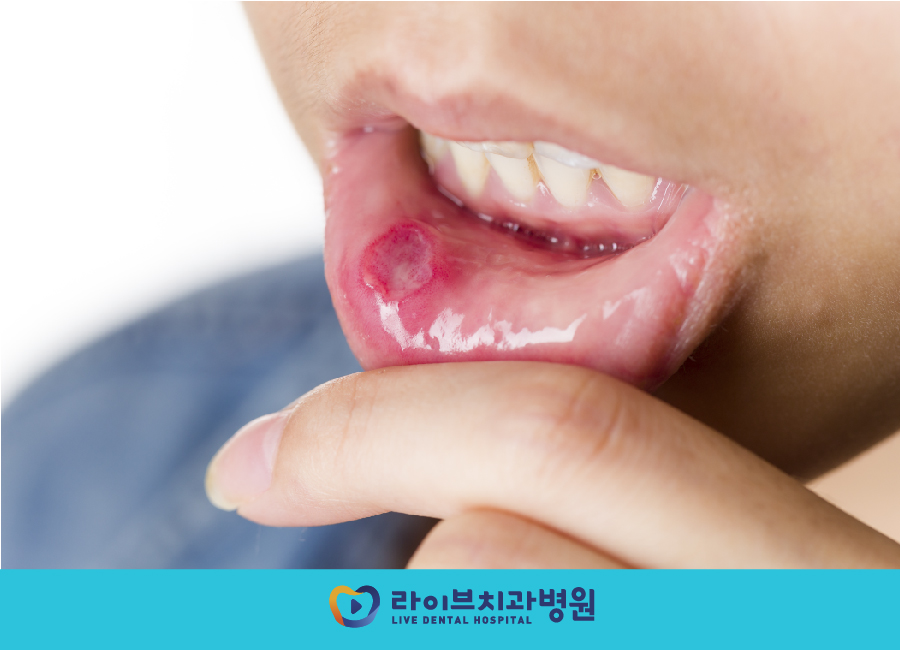 구내염 빨리 낫는법, 꿀팁 3가지 공유 관련 이미지 2