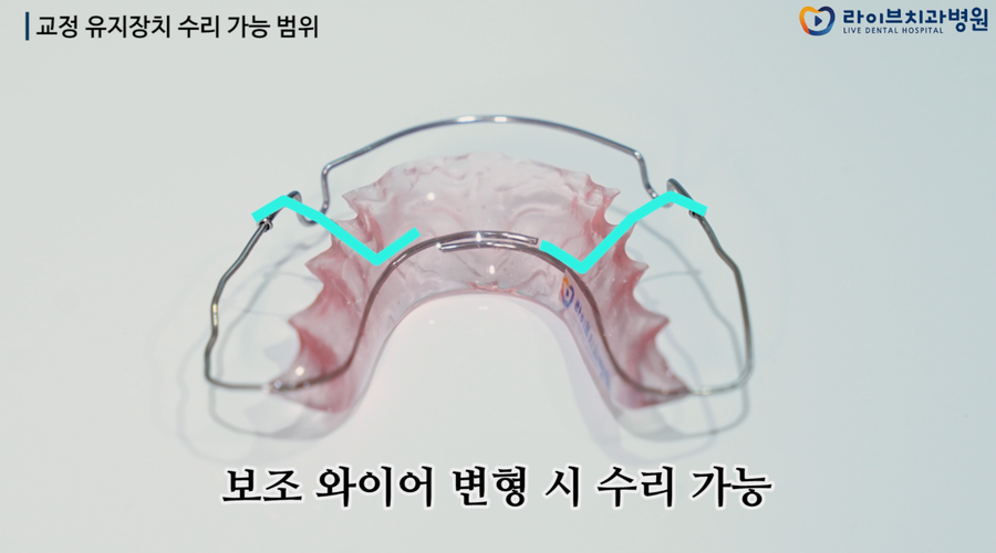 교정장치의 종류와 내구성 그리고 유지장치의 수리 가능 범위 관련 이미지 2