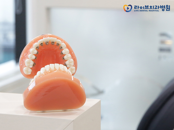 치아교정장치, 장점과 단점은 무엇일까요? 관련 이미지 7
