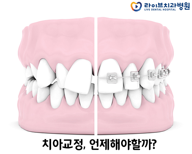 치아교정시기 꼭 정해져 있나요? 관련 이미지 2