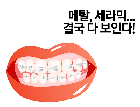 설측교정, 보이지 않는다 아무것도! 관련 이미지 3