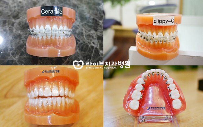 치아교정장치, 장점과 단점은 무엇일까요? 관련 이미지 2