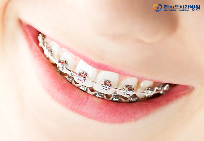 치아교정기간, 내 케이스는 얼마나 걸릴까? 관련 이미지 2