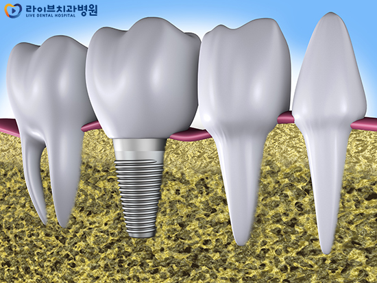 어금니임플란트 자세히 알아보고 시작하자 관련 이미지 4