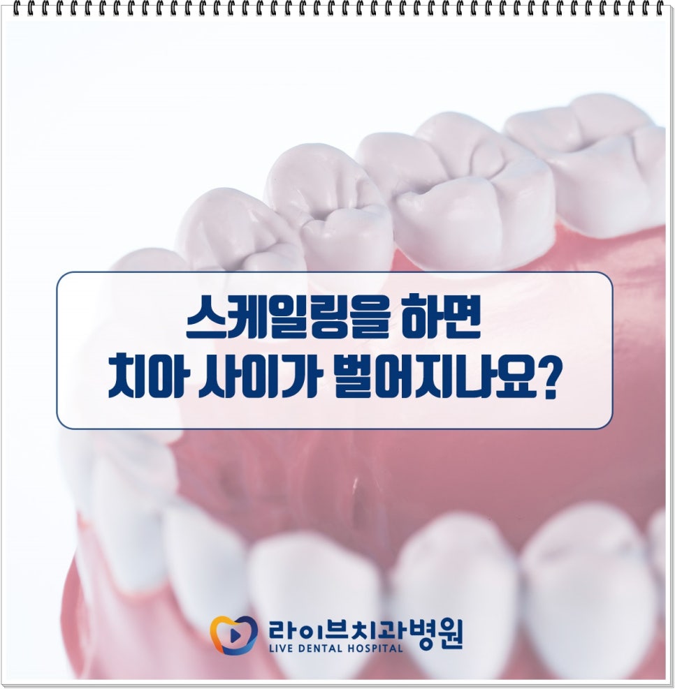 치석제거를 위한 스케일링 궁금증 풀어봐요 관련 이미지 4