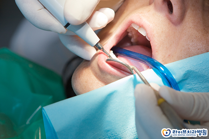 썩은사랑니발치 해야하나요? 관련 이미지 3