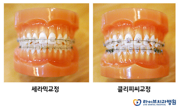 앞니교정, 고르고 가지런한 앞니를 위하여 관련 이미지 4