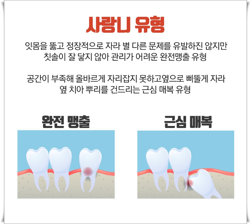 사랑니 유형과 발치 후 주의사항 정보 관련 이미지 3