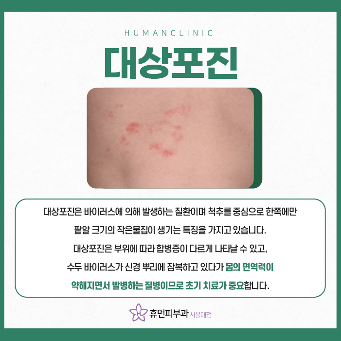 대상포진전염성 예방접종이 효과 있을까? 관련 이미지 2