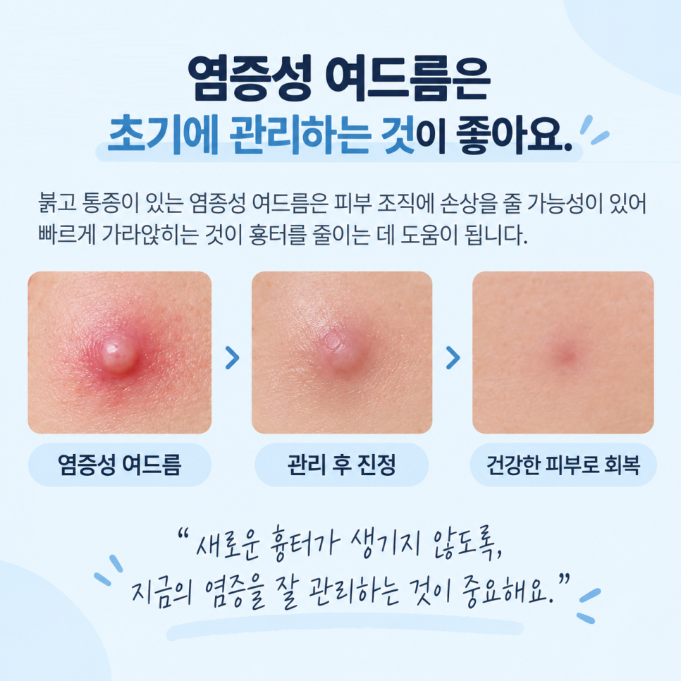여드름이 생겼을 때 흉터를 줄이려면 어떻게 해야 할까? 관련 이미지 4