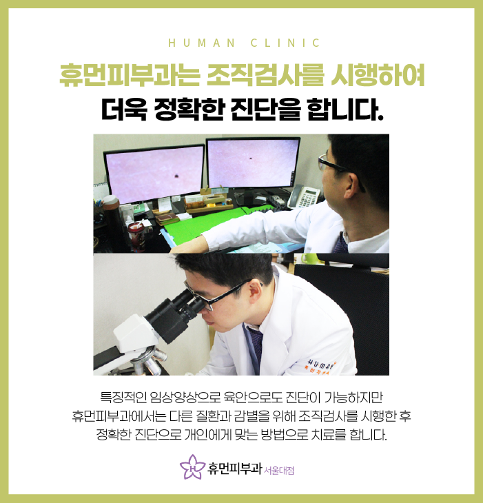 서울대역피부과 사마귀치료 더 심해지기 전에 관련 이미지 4