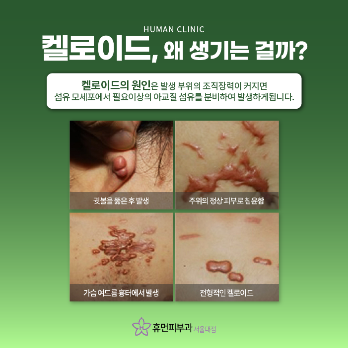 켈로이드피부과 최고의 치료 효과 보장하는 피부과? 관련 이미지 3
