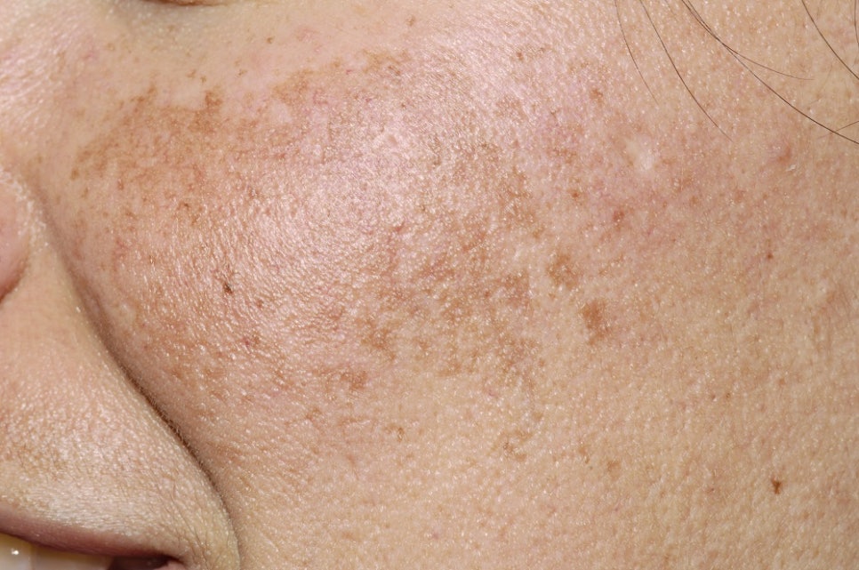 How to Manage Increasing Melasma Like This image 3