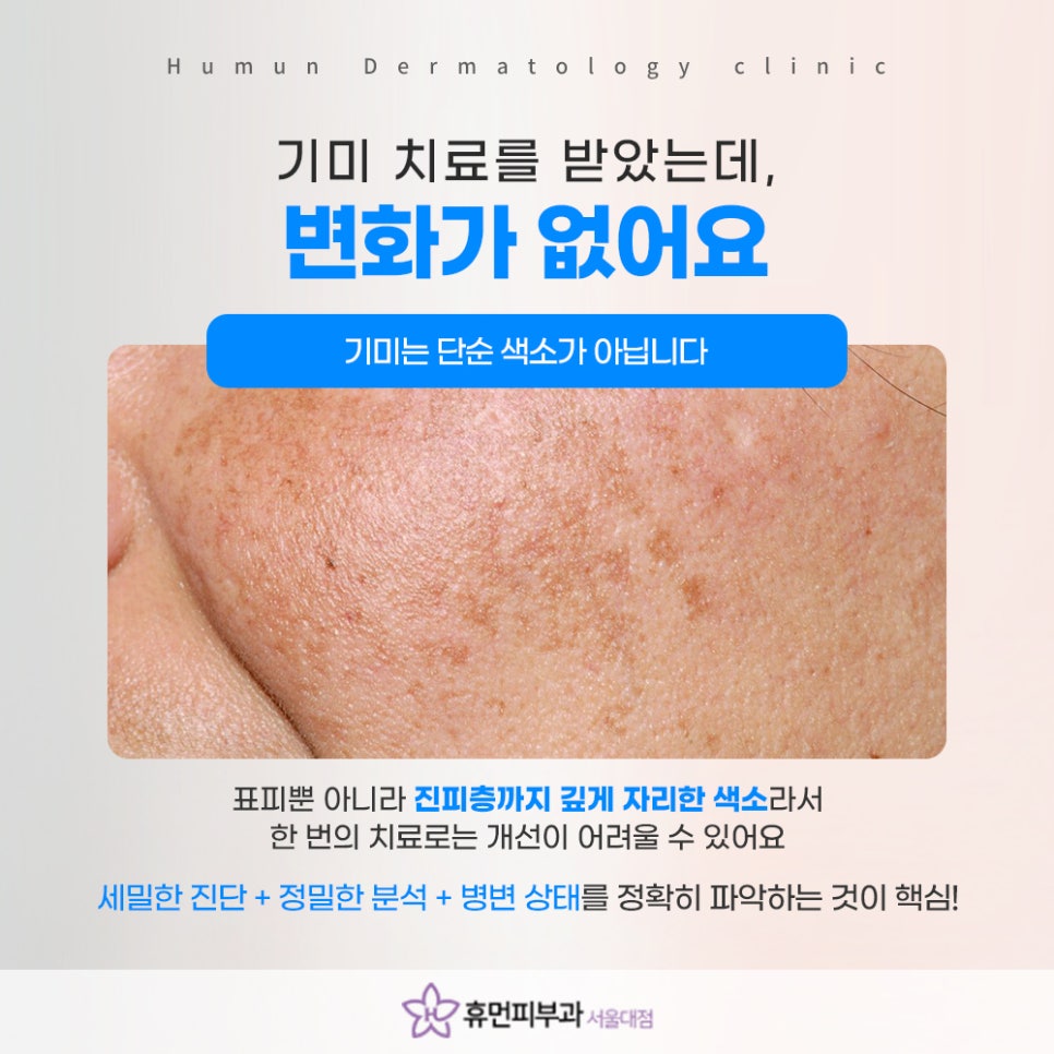 Customized Diagnosis You Must Check at a Sillim Melasma Dermatology Clinic image 5