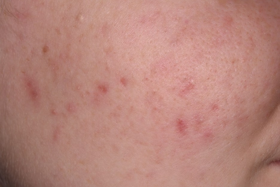 Treating Acne Near SNU Entrance Station with GOLD PTT image 8