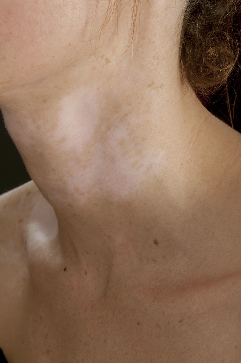 What Are the White Spots That Appear on the Skin? Vitiligo image 6