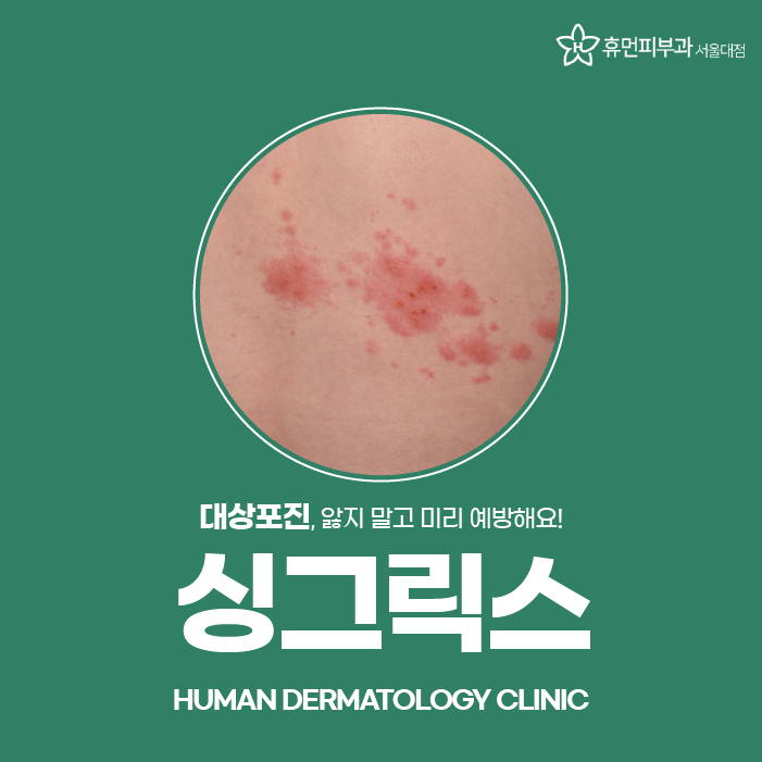 대상포진전염성 예방접종이 효과 있을까? 관련 이미지 1