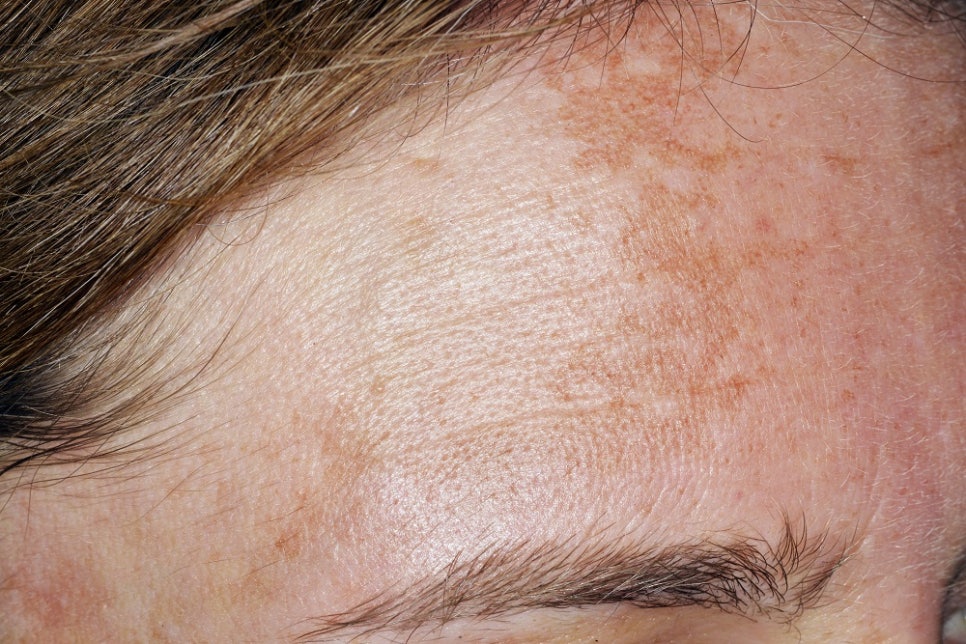 How to Manage Increasing Melasma Like This image 2