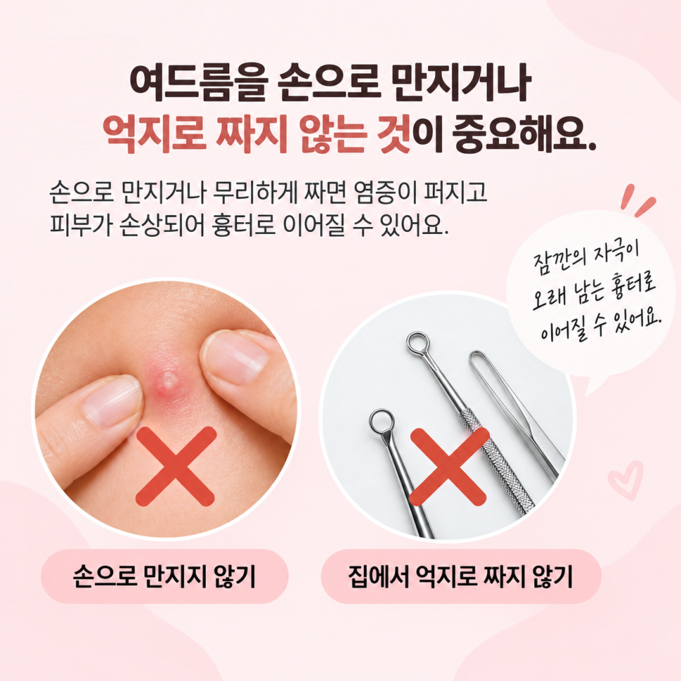 여드름이 생겼을 때 흉터를 줄이려면 어떻게 해야 할까? 관련 이미지 2