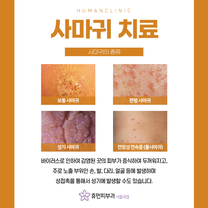 사당역피부과, 사마귀 관리 꼼꼼하게 하려면? 관련 이미지 3