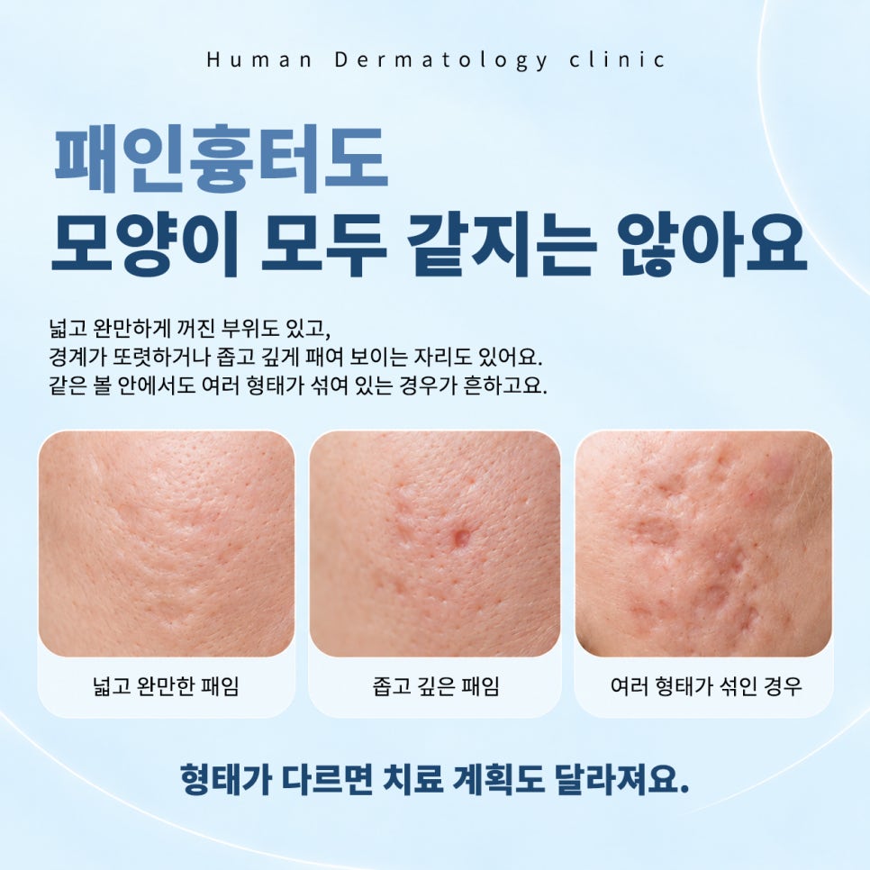 서울대입구피부과 여드름흉터, 자국과 패임을 먼저 나눠서 보는 이유 관련 이미지 4