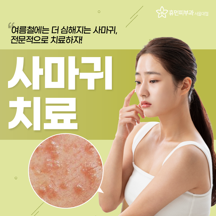 서울대역피부과 사마귀치료 더 심해지기 전에 관련 이미지 1