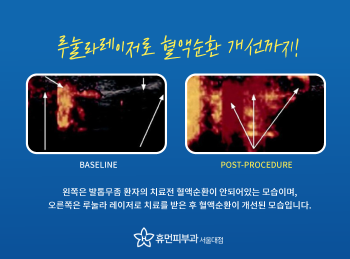 난곡동피부과 발톱무좀 재발은 이제 그만 관련 이미지 4
