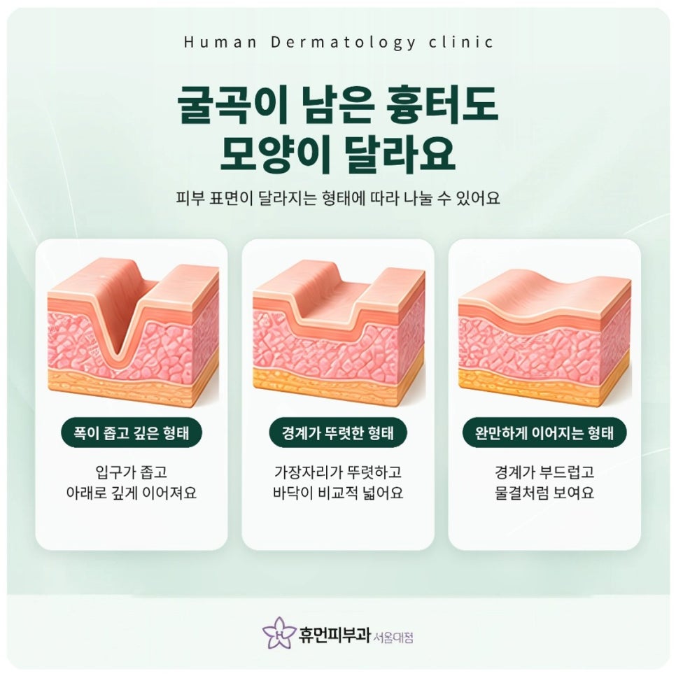 서울대입구피부과 여드름흉터, 자국일까 흉터일까 먼저 구분해요 관련 이미지 4