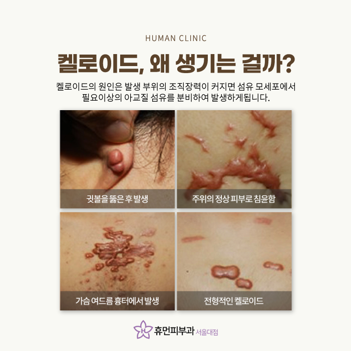 켈로이드피부과 어떻게 치료하나요 관련 이미지 3