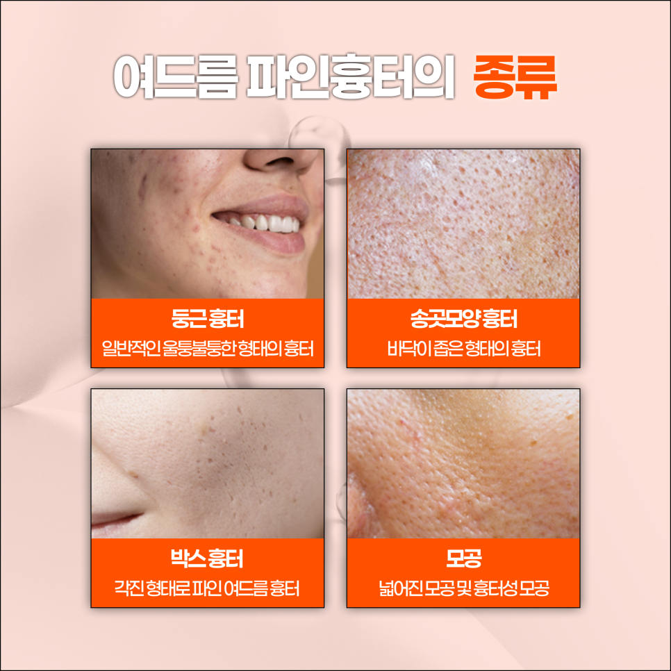 Are Acne Scars in SNU Entrance Just Going to Stay There? image 5