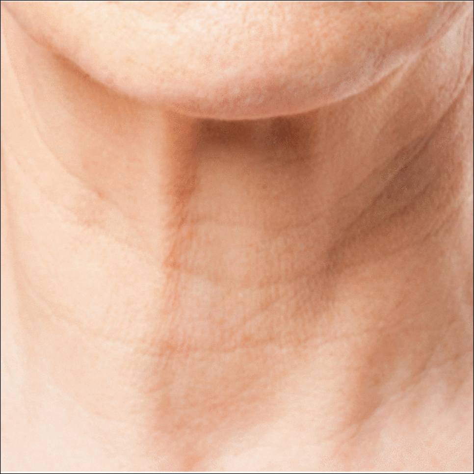 How to Improve Deepening Nasolabial Folds with Radiesse in Sillim image 6