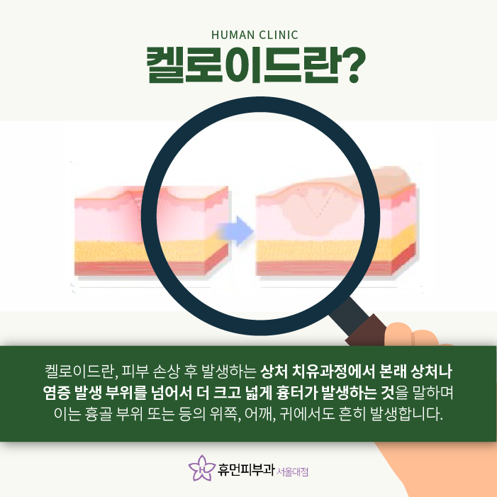 켈로이드피부과 최고의 치료 효과 보장하는 피부과? 관련 이미지 2