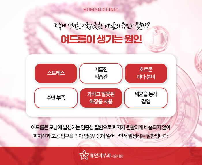 여드름자국레이저 여드름 제네시스 브이빔 LDM으로 여드름관리 해보자 관련 이미지 2