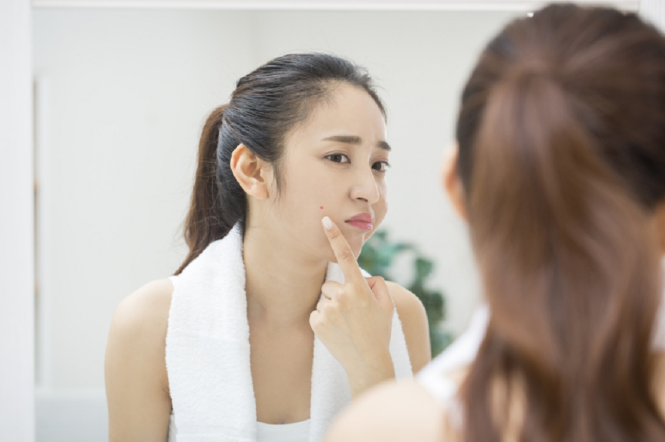 Why Breakouts Around the Mouth & Jaw Keep Recurring image 3