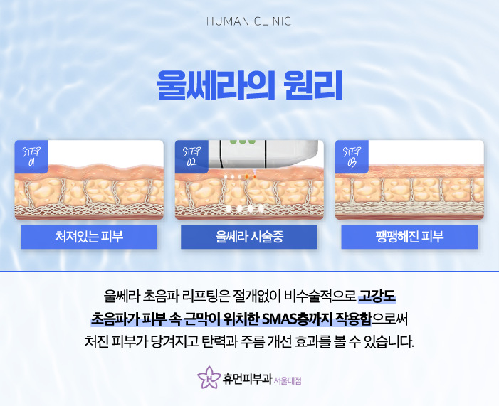 서울대입구역피부과 서울울쎄라로 동안 피부 만들기 관련 이미지 3