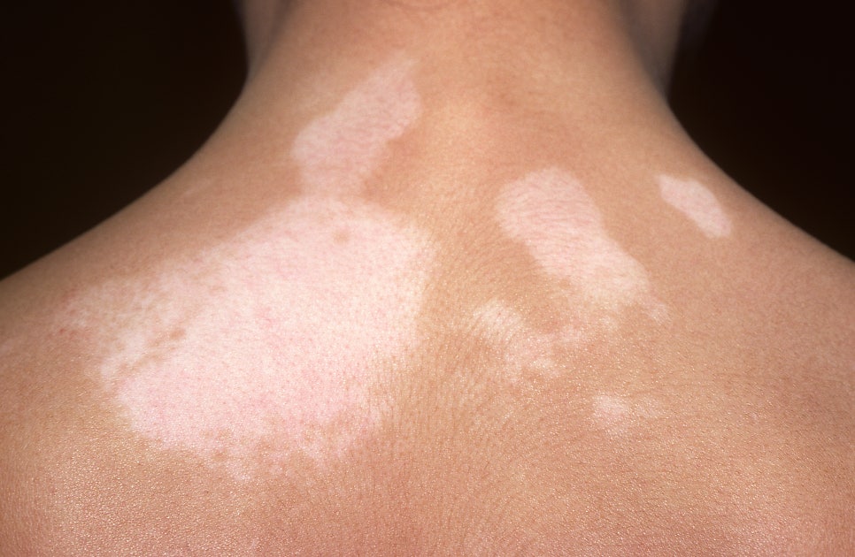 What Are the White Spots That Appear on the Skin? Vitiligo image 4