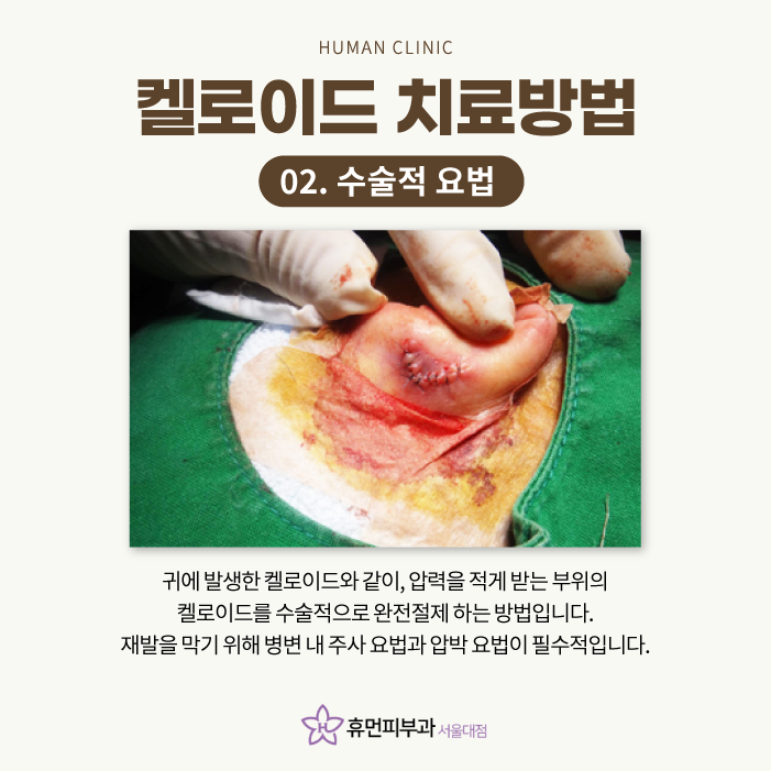 켈로이드피부과 어떻게 치료하나요 관련 이미지 5
