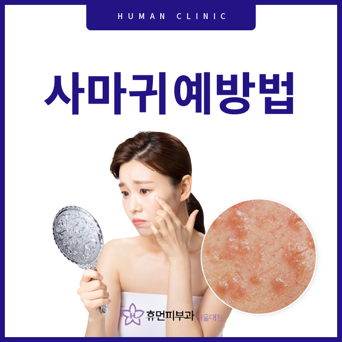 사마귀예방법은 뭐가 있을까요? 관련 이미지 1
