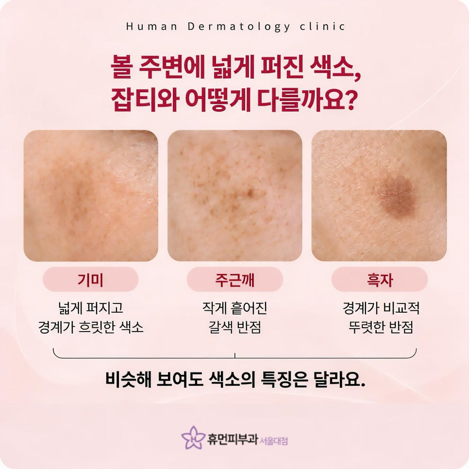 낙성대피부과 기미, 볼 주변에 번지는 색소가 신경 쓰인다면 관련 이미지 3