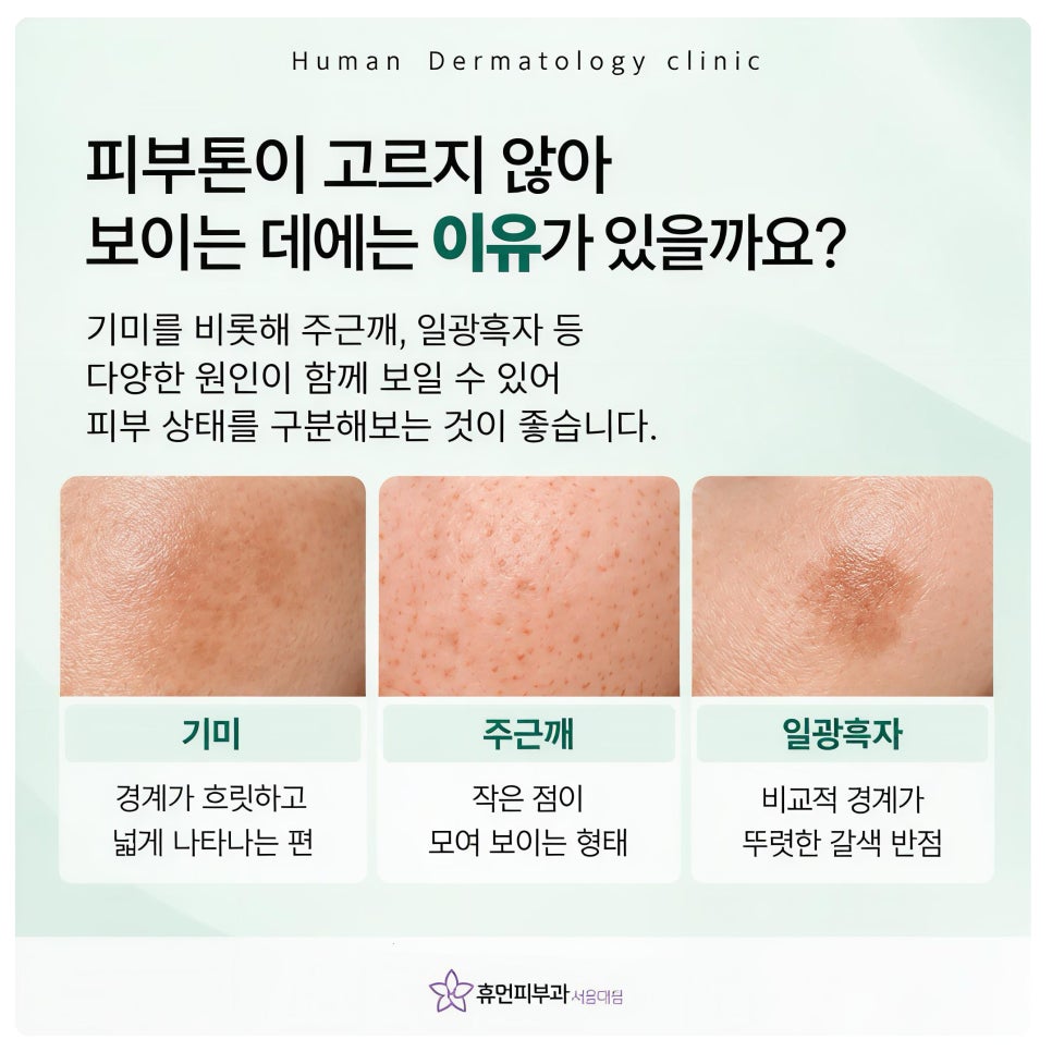 서울대입구역피부과 기미, 피부톤이 고르지 않아 보이는 이유 관련 이미지 3