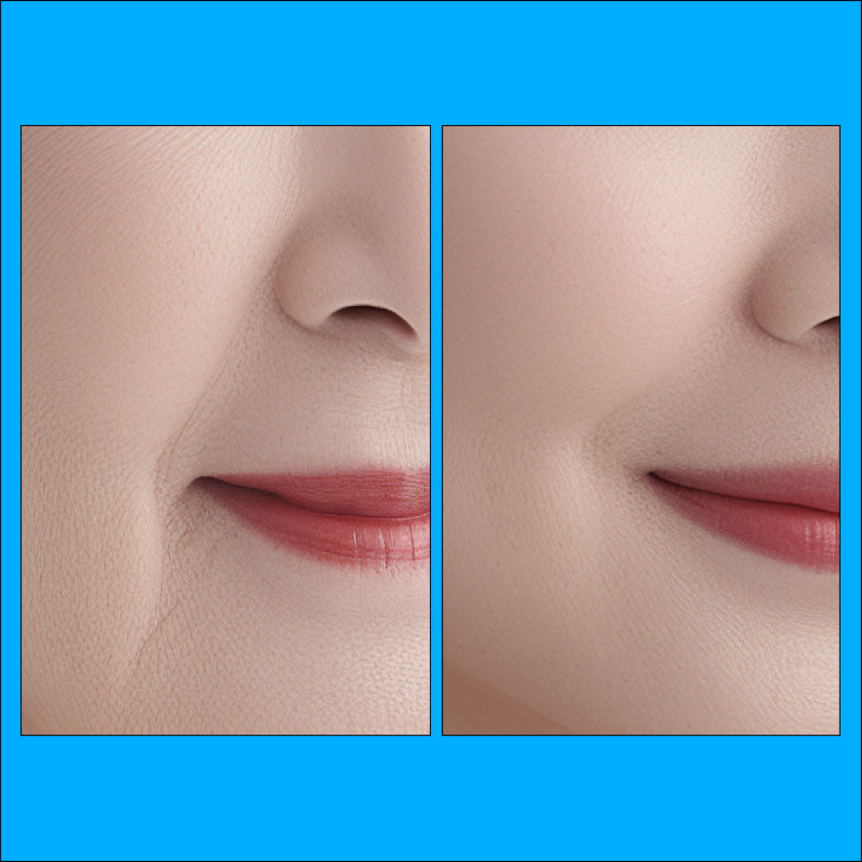 How to Improve Deepening Nasolabial Folds with Radiesse in Sillim image 1