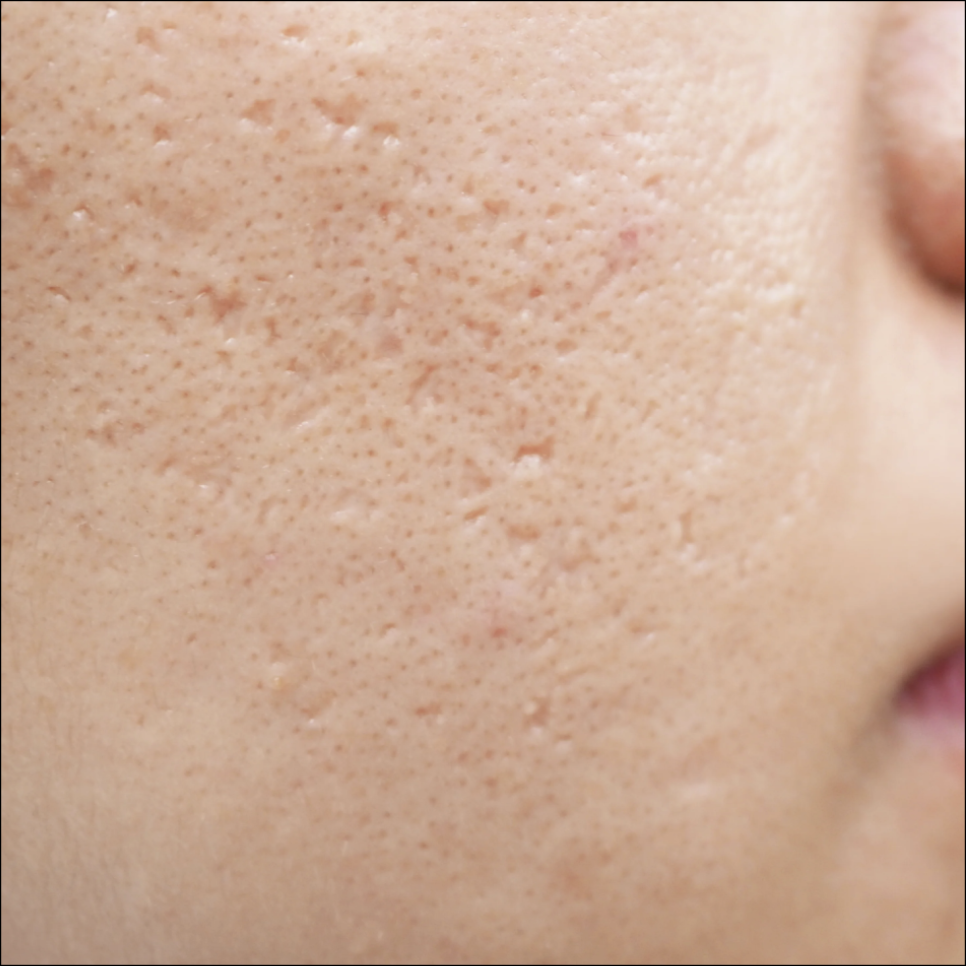 Are Acne Scars in SNU Entrance Just Going to Stay There? image 6