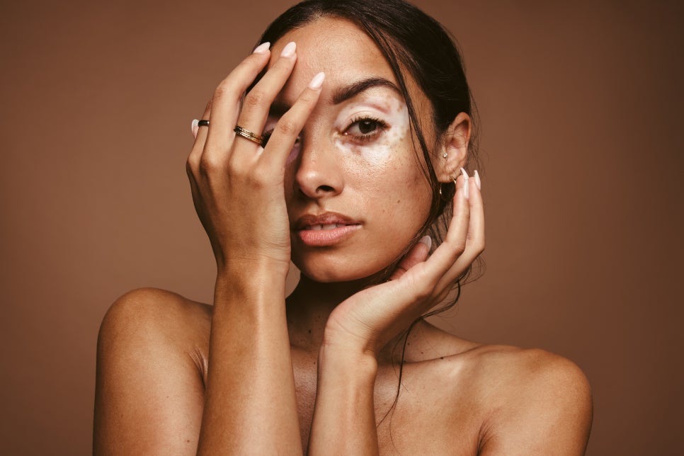 What Are the White Spots That Appear on the Skin? Vitiligo image 1