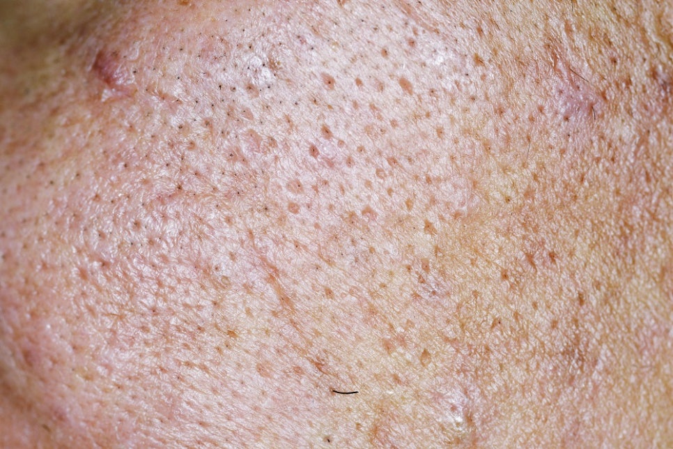 Why Don’t Pores Get Smaller? image 1