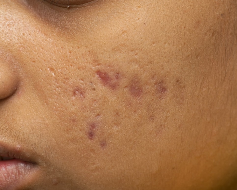 Can Acne Scar Treatment Be Done with Just One Laser Session? image 2