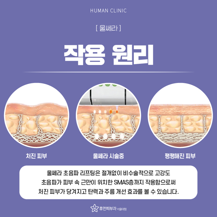 상도동피부과 처진 얼굴살 개선 방법은 무엇일까? 관련 이미지 3