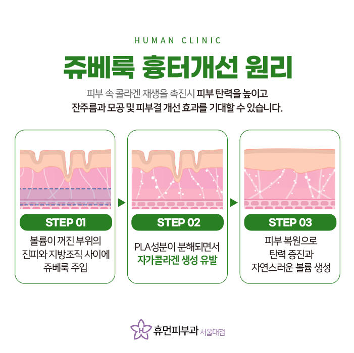 관악구피부과추천 쥬베룩으로 내 얼굴에 차오르는 볼륨 관련 이미지 4