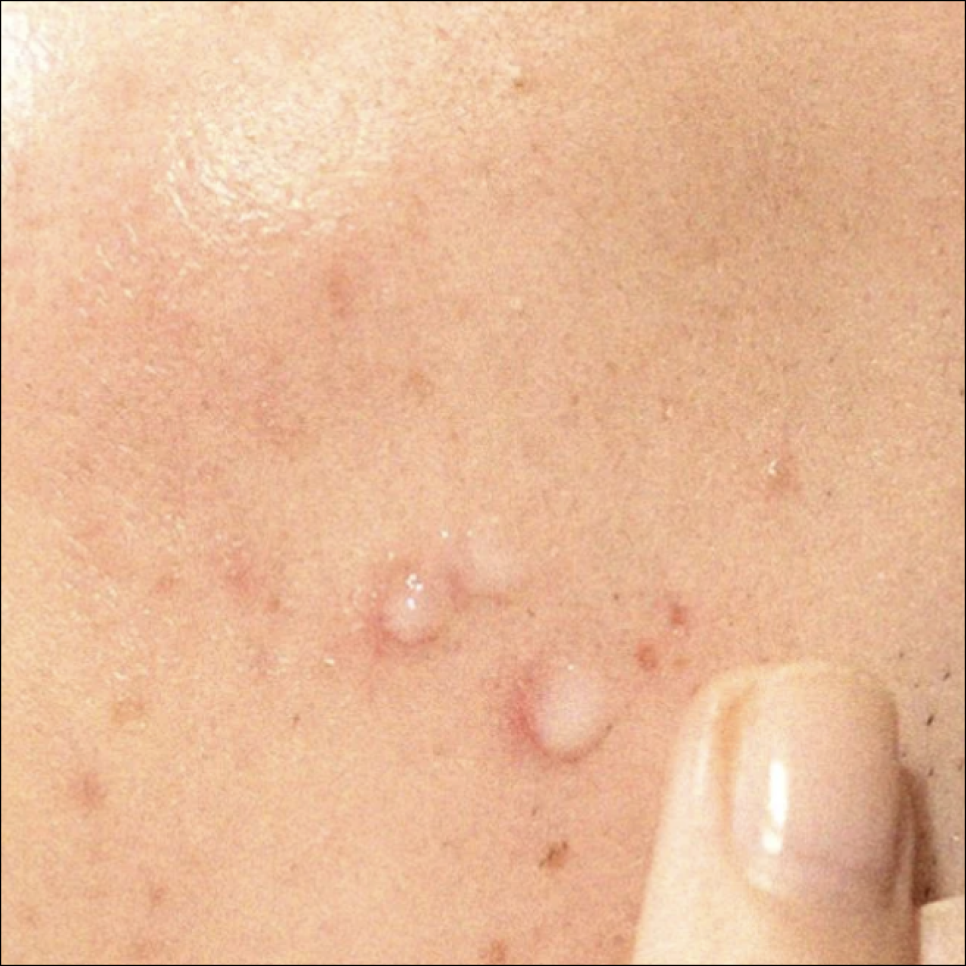 Are Acne Scars in SNU Entrance Just Going to Stay There? image 8