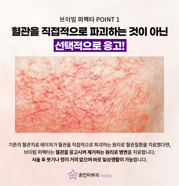 낙성대피부과 혈관질환 효과적으로 치료해요 관련 이미지 3