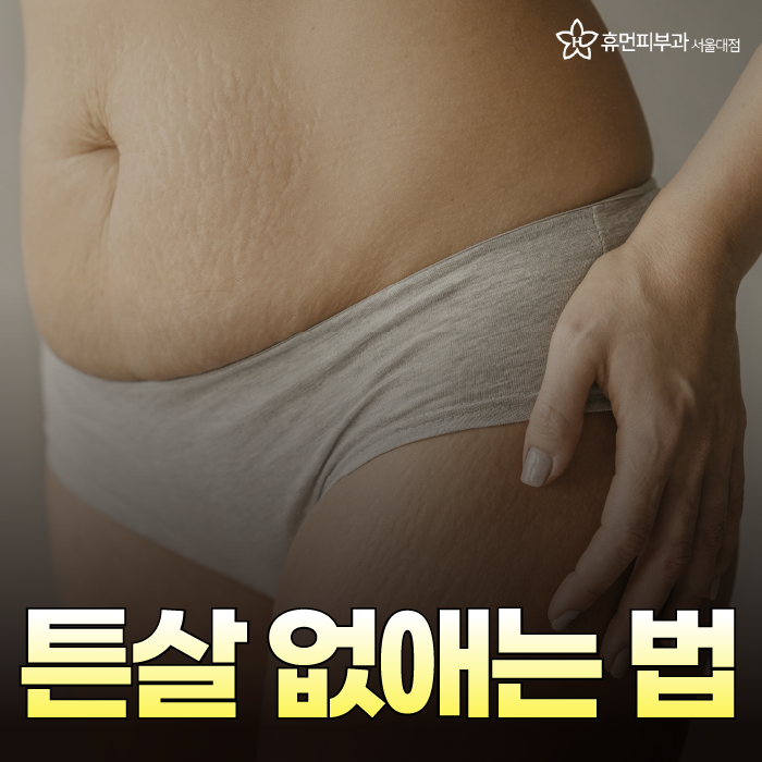 튼살 없애는 법 뭐가 있을까요? 관련 이미지 1